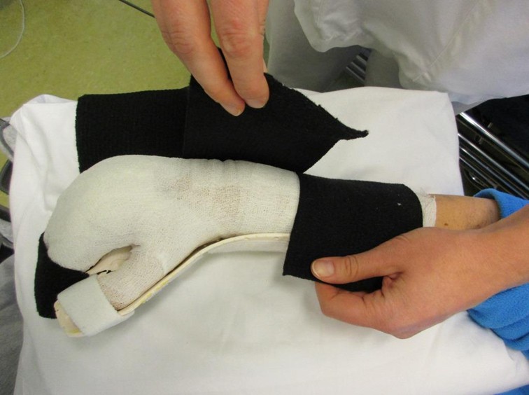 En person som har på en ortose på hånden