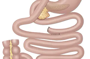 gastric bypass-stor.jpg