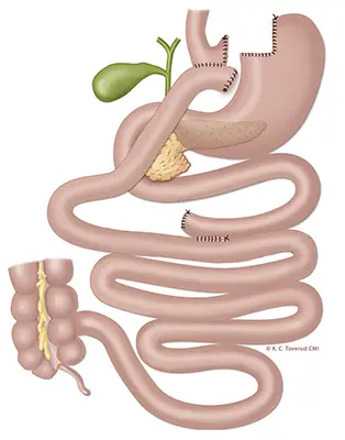 gastric bypass-stor.jpg