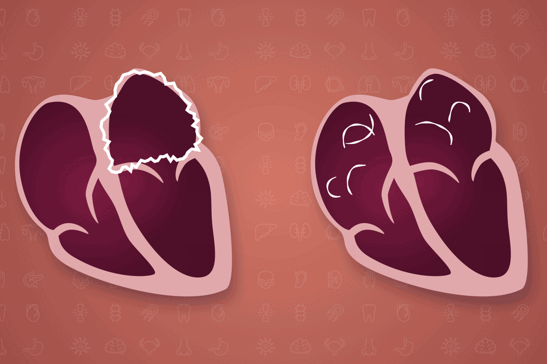 Illustrasjon av anatomien til to hjerter.