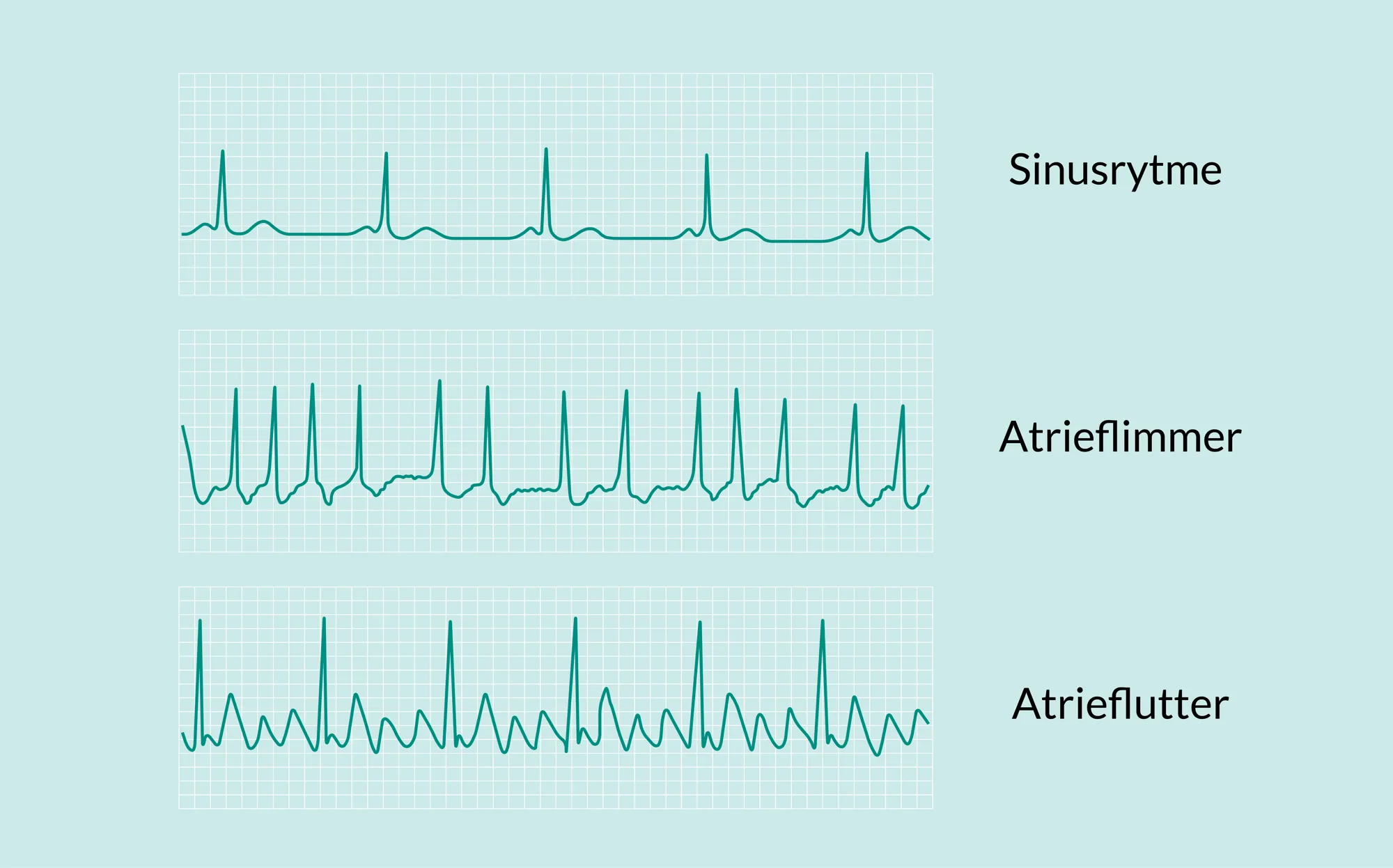 Diagram med sinusrytme, atrieflimmer og atrieflutter