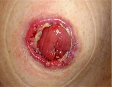 Mukokutan separasjon