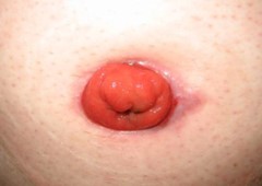 Mukokutan separasjon