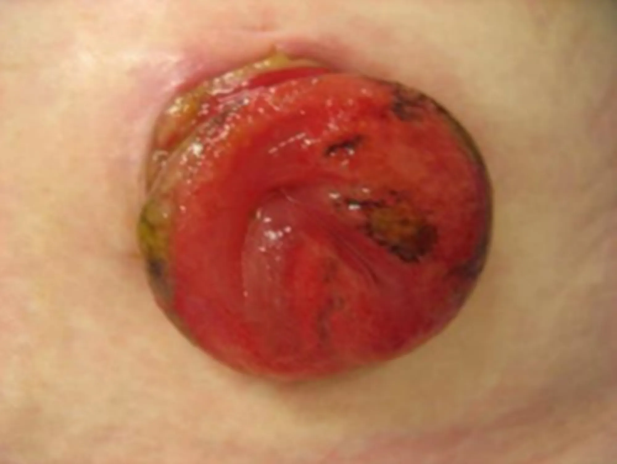 Stominekrose