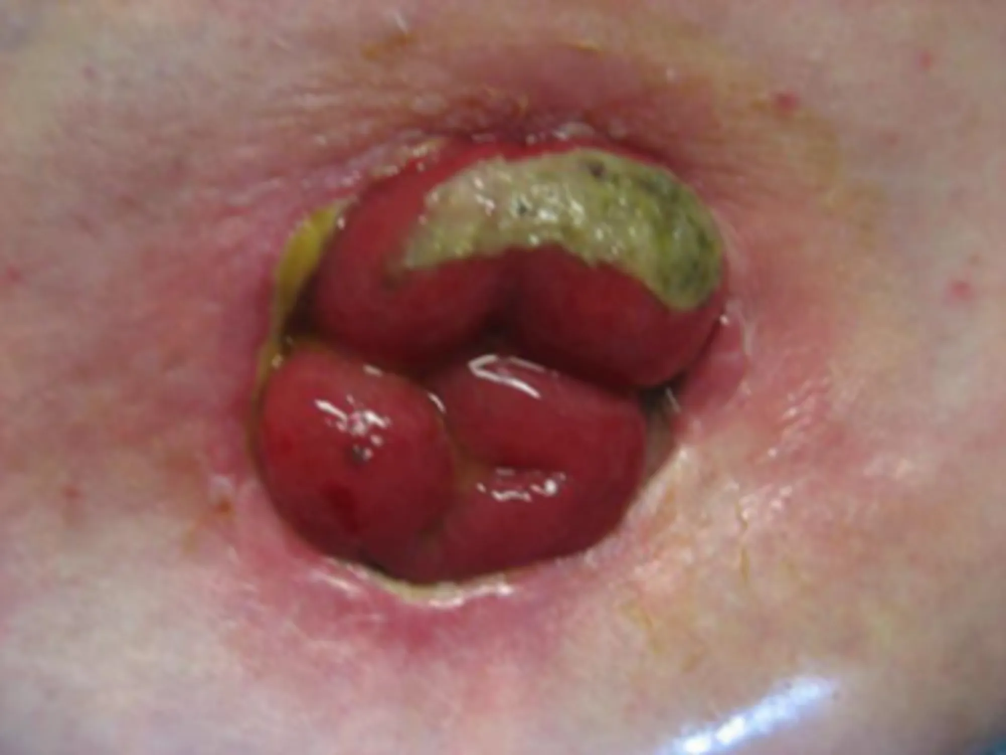 Stominekrose