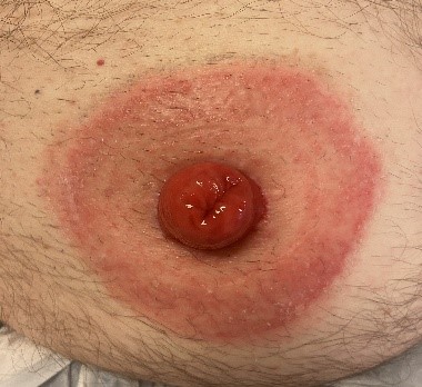 stomi med hudskade