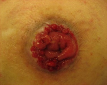 Granulasjonspolypper