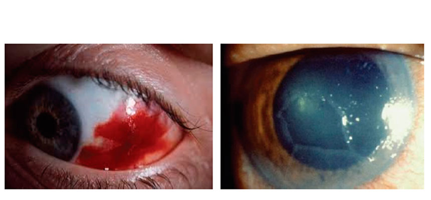 Bildet av øye brodutredning og bildet av sår på hornhinnen.
