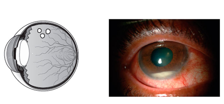 Bildet av øye med luftbobler og bilde av infeksjon.
