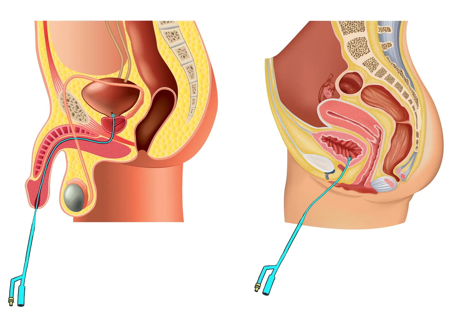 Anatomisk plassering av kateterslange hos mann og kvinne. Grafikk.