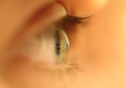 Et nærbilde av et øye, der hornhinnen buler fremover.