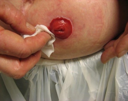 Kolostomi med en åpning