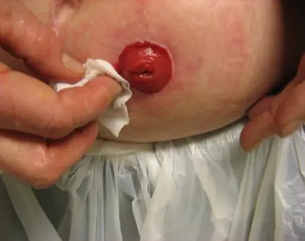 Kolostomi med en åpning