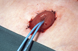 Et nærbilde av en persons hud med stomi