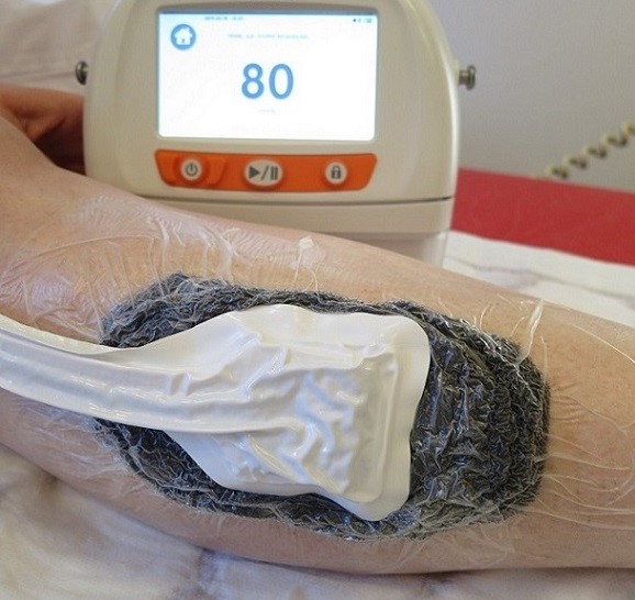 Foto av pumpa som blir brukt i undertrykksbehandling
