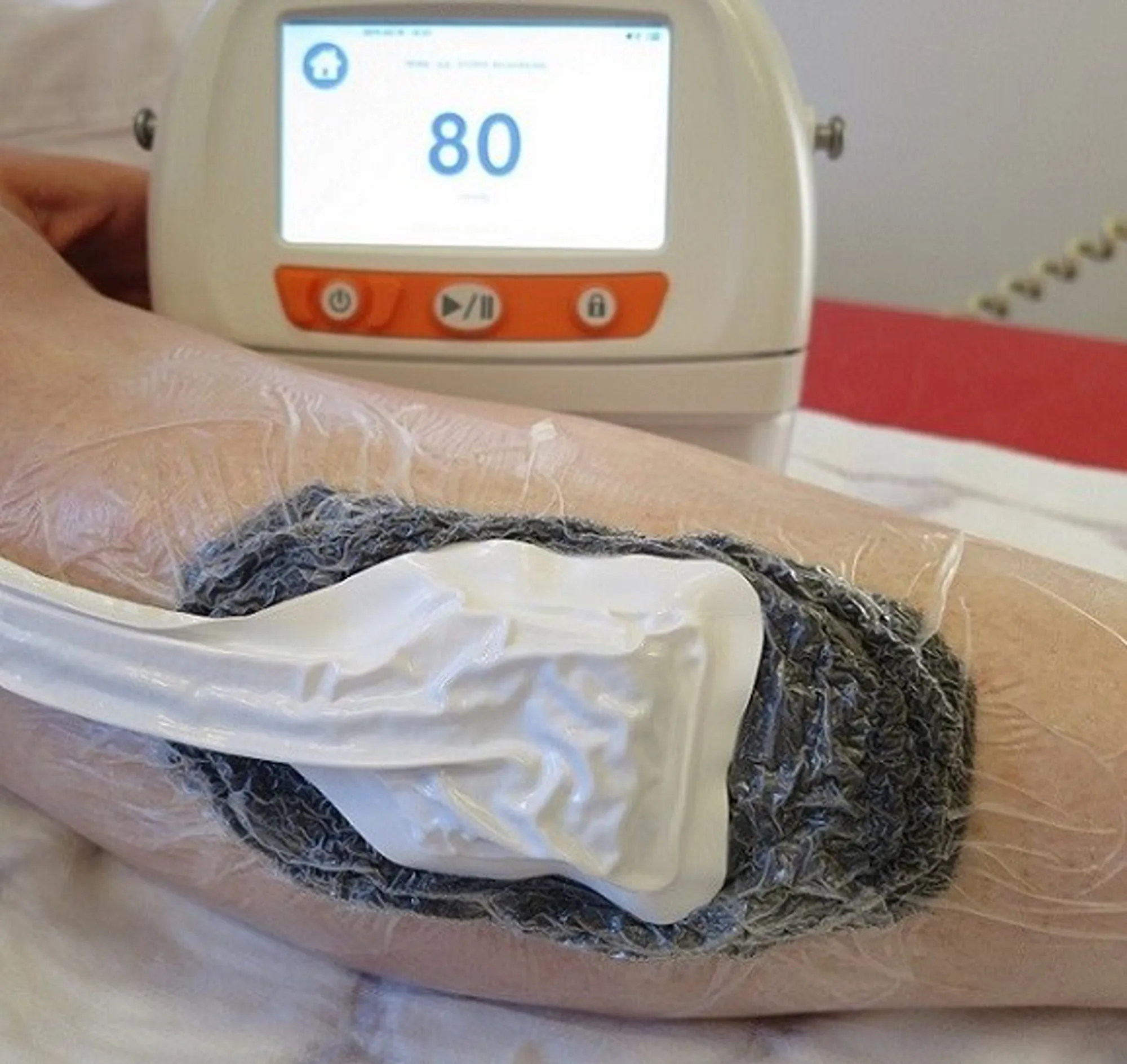 Foto av pumpen som brukes i undertrykksbehandling