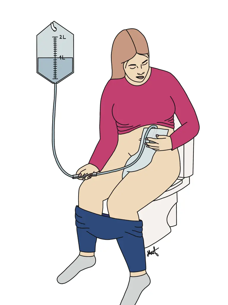 Kvinne med stomi som sitter på et toalett