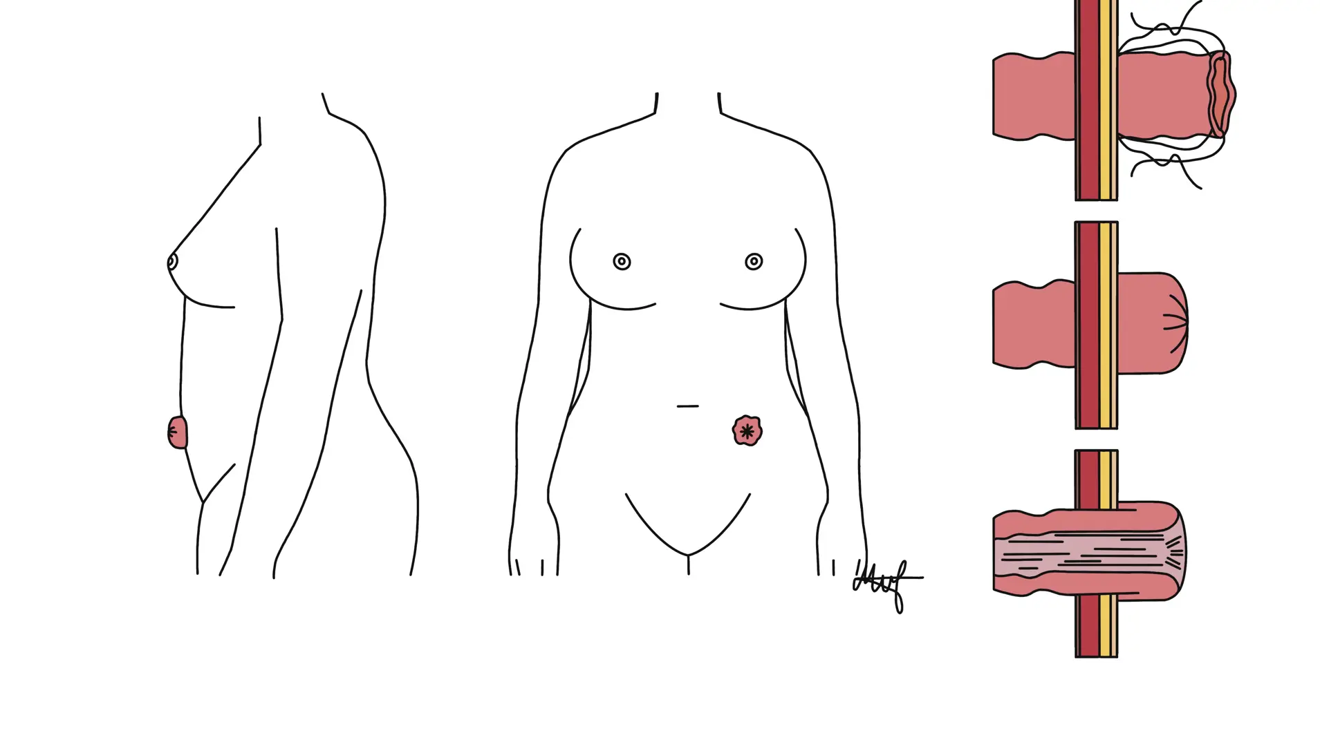 Tegning av en-løpet stomi