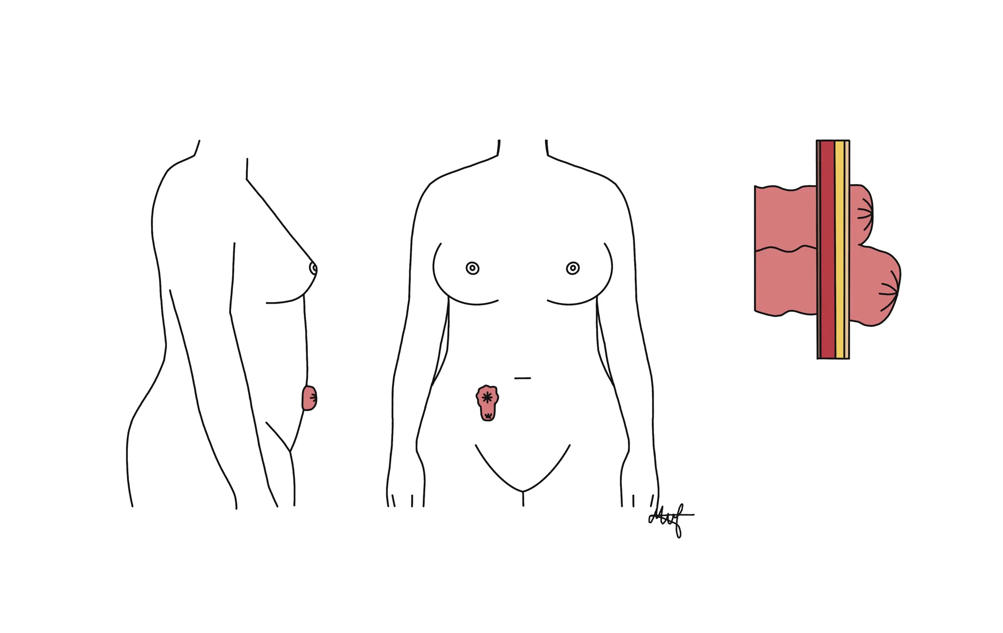 Tegning av toløpet stomi