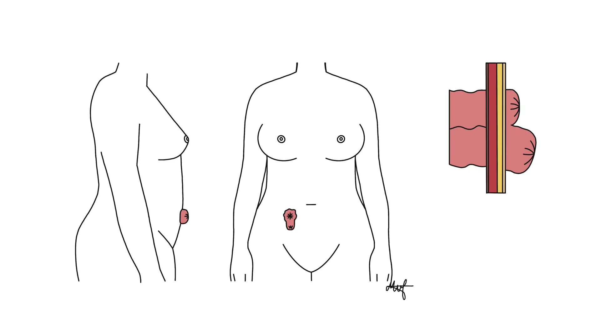 Tegning av toløpet stomi