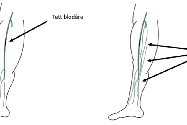 Tegning av legger med tette blodårer. Tegning.