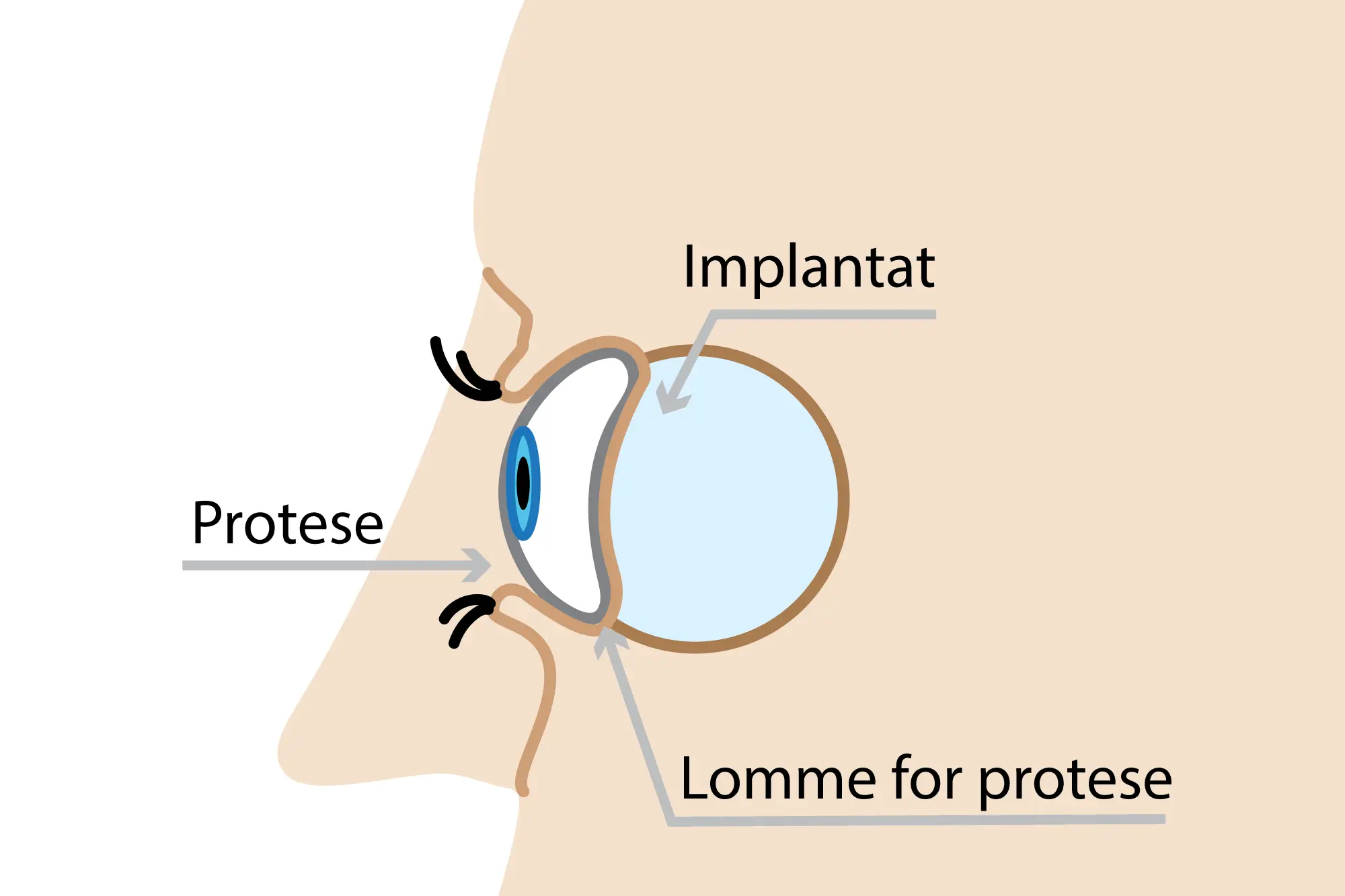 Illustrasjon av protese i øyehulen. Tegning