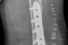 røntgenbilde pasient med plate.foto