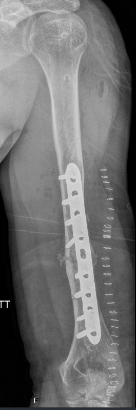 røntgenbilde pasient med plate.foto
