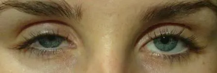 Bildet viser øynene til en person hvor det ene øyelokket tydelig henger ned i synsfeltet. Foto.