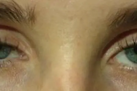 Bildet viser øynene til en person hvor det ene øyelokket tydelig henger ned i synsfeltet. Foto.