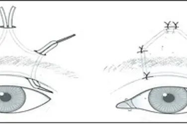 Bildet viser operasjonsmetode hvor vi får løftet øyelokket ved hjelp av pannemusklaturen. Illustrasjonsfoto.