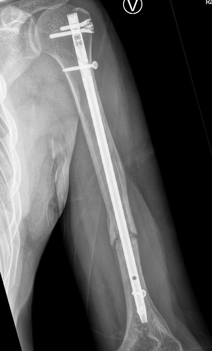 rngtbilde nagle_foto