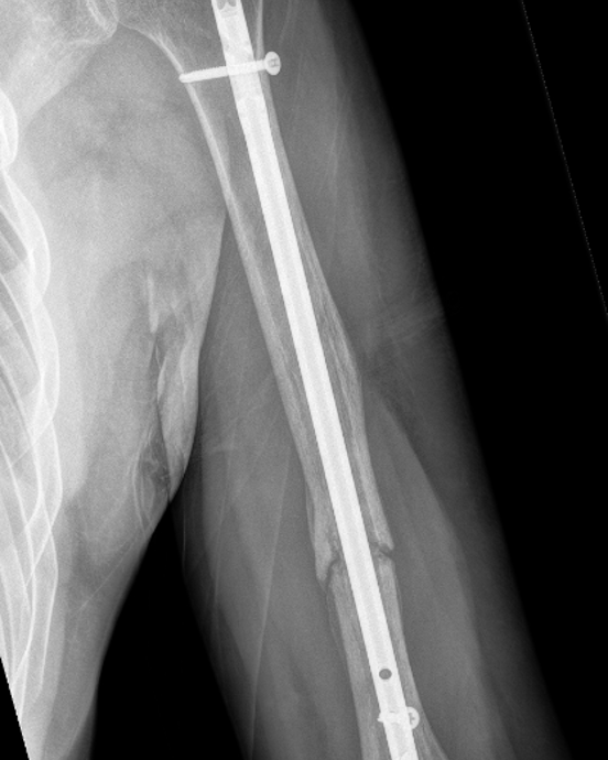 rngtbilde nagle_foto