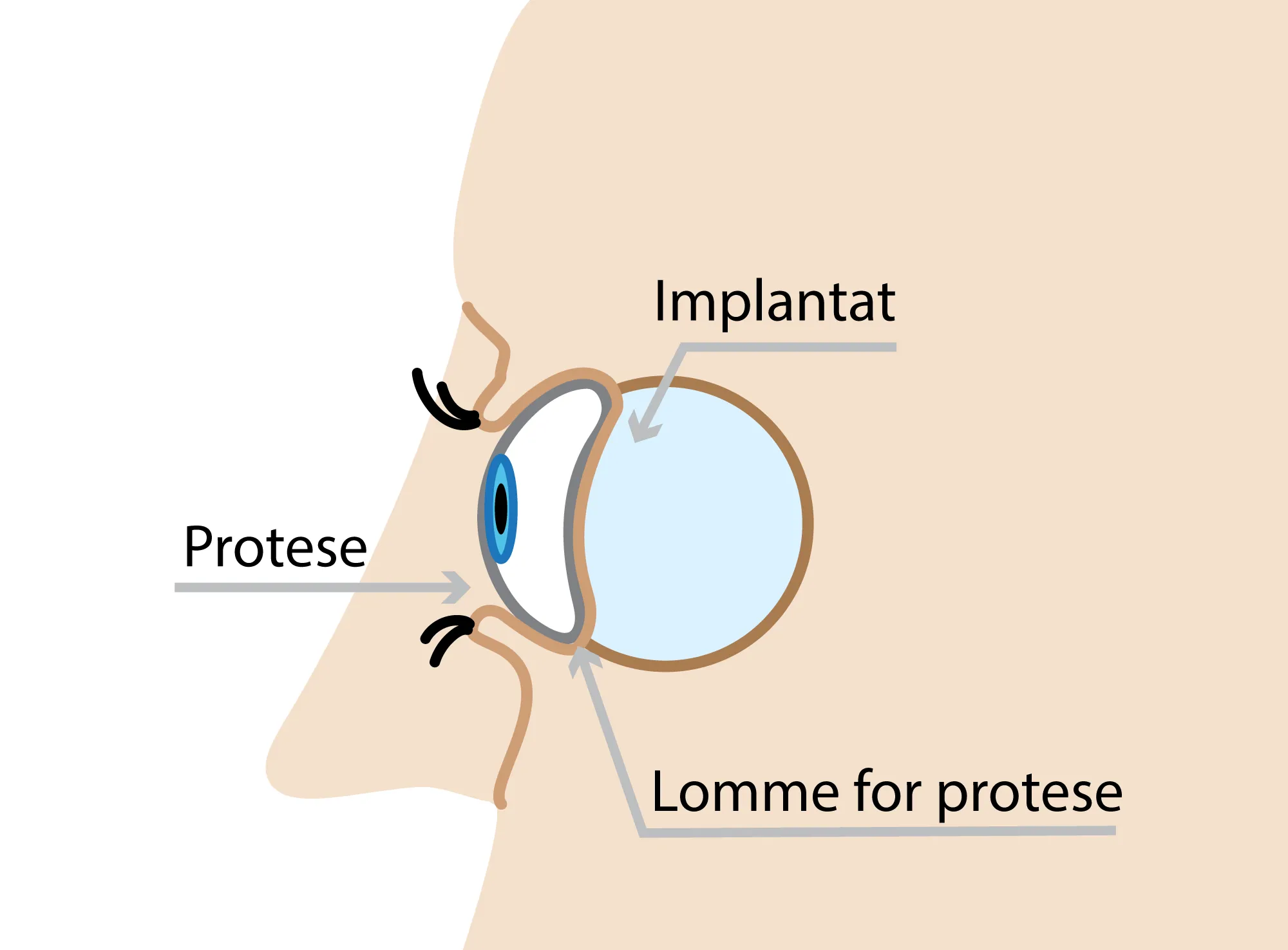 illustrasjon av auge implantat