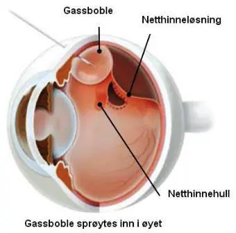 Bilde-netthinneløsning2.jpg