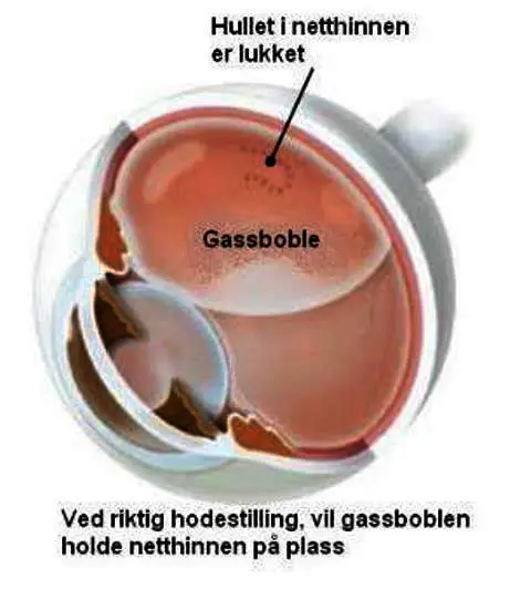 Bilde-netthinneløsning3-ny.jpg
