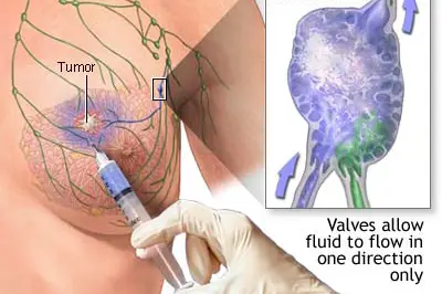 Vaktpostlymfeknuten