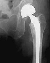 Røntgenbildet viser hvordan hemiprotesen er satt inn i hofta/beinet.