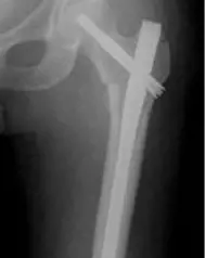 Røntgenbilde av hvordan en margnagl blir satt inn i hofta/foten. Foto.