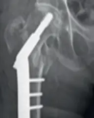 Røntgenbildet viser hvordan platen og skruene er festet til hofta/beinet. Foto.