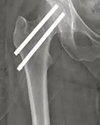 Røntgenbildet viser hvordan to skruer er satt inn i hofta/beinet. Foto.
