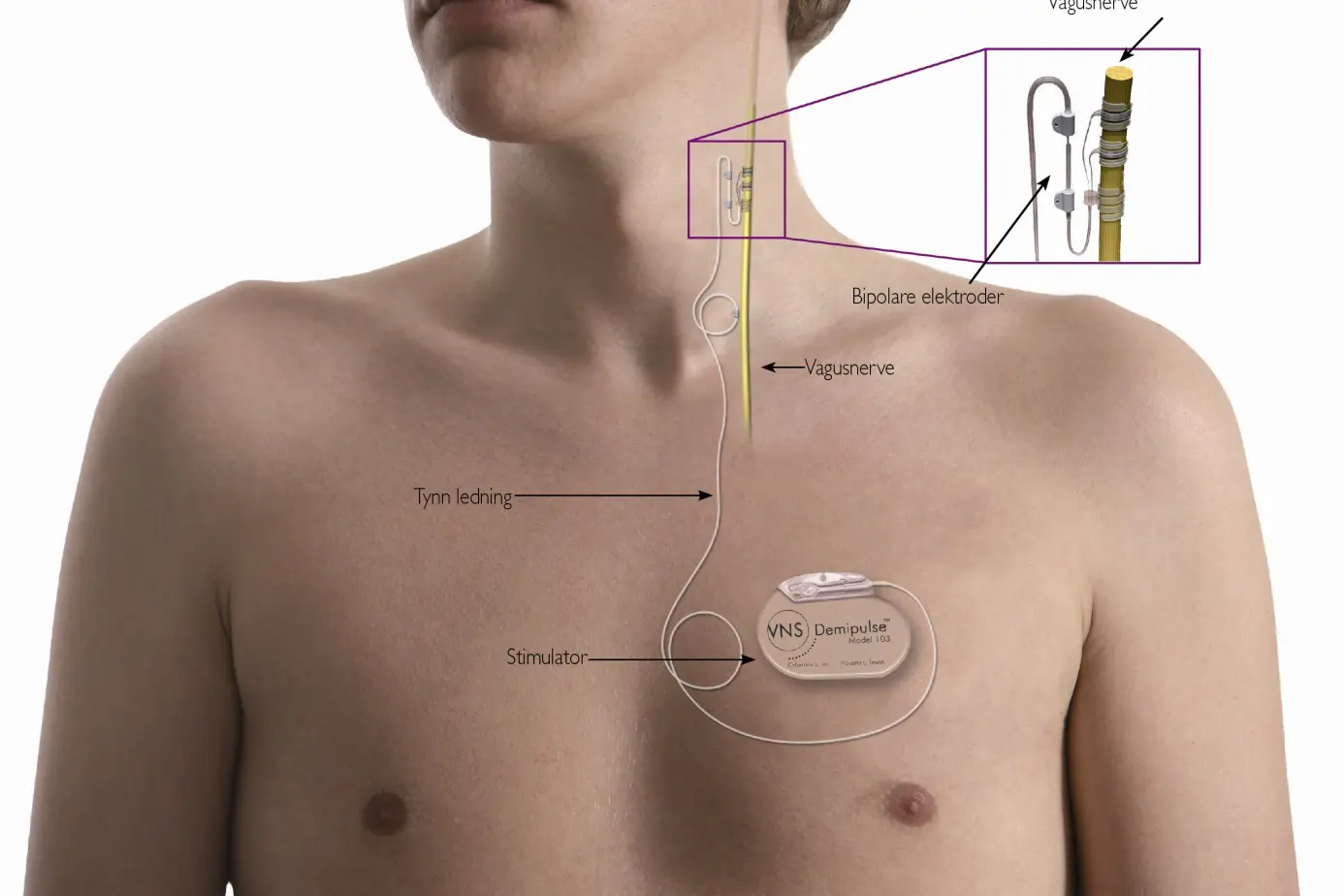 Illustrasjon av hvor stimulator sitter når den er operert inn. Bilde