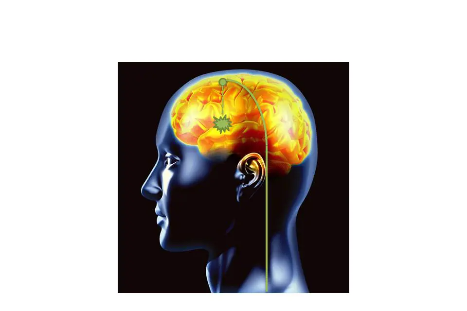 Illustrasjonsfoto av en hjerne og hvordan elektrodene skal plasseres for å få til hjernestimuleringen.