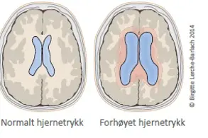 Illustrasjon av normalt og forhøyet hjernetrykk. Bilde