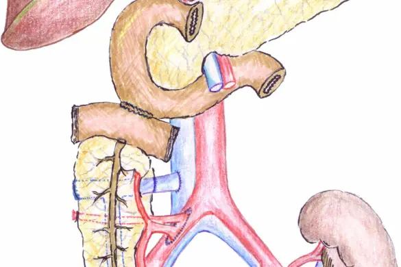 Bildet viser en tegning av nyre- og bukspyttkjerteltransplantasjon