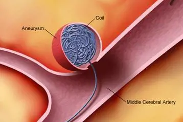 Illustrasjon av tynne metalltråder som føres gjennom innsiden av en blodåre
