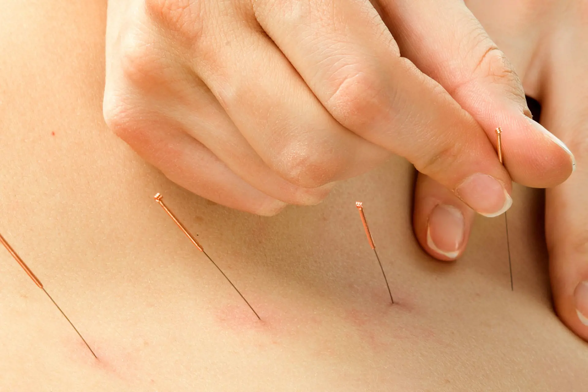 Akupunkturnåler på hud. Foto
