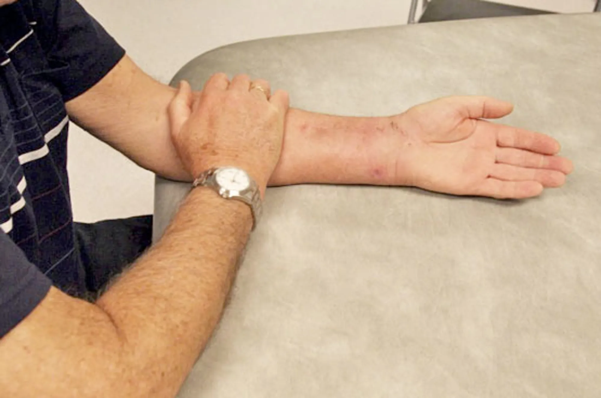 En arm hviler med håndflaten ned. Frisk arm hjelper skadd arm. Foto