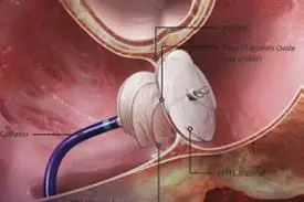 Illustrasjon av en paraply