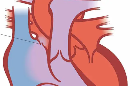 Illustrasjon av hjertet PFO